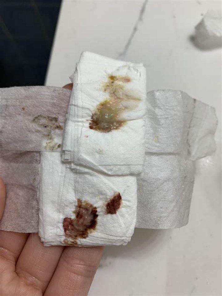 Are spitting stitches common? | ContextResponse.com