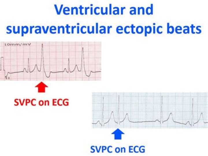 Are supraventricular ectopic beats normal?