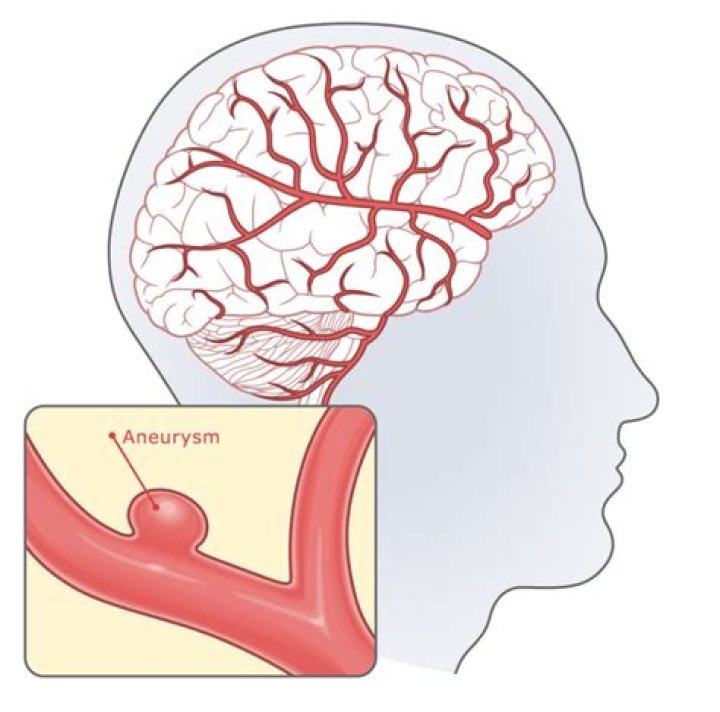 At which junction are aneurysms most common?