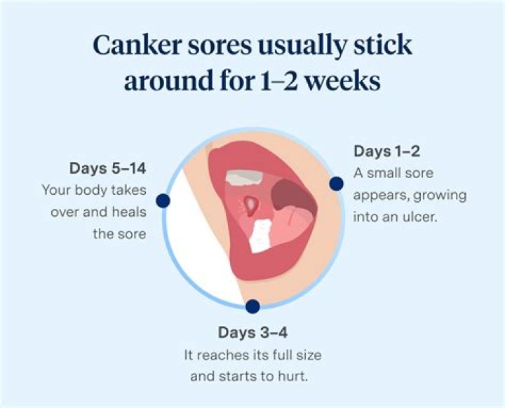 Can a canker sore cause ear pain?