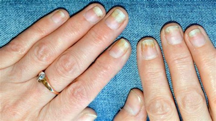 Can a damaged nail bed be fixed?