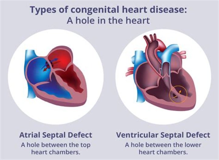 Can a hole in your heart kill you?