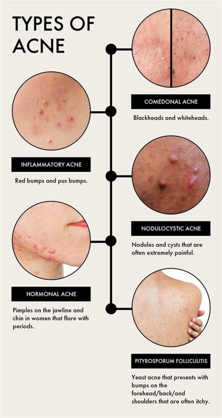 Can acne holes be cured?