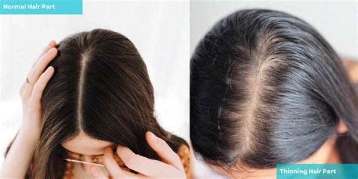 Can anything be done about thinning hair?