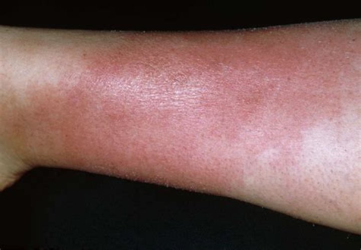 Can cellulitis cause blood clots?