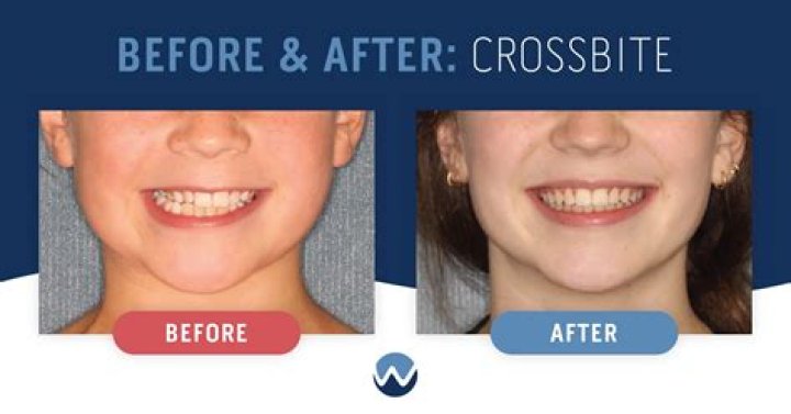 Can Crossbite be fixed in adults?