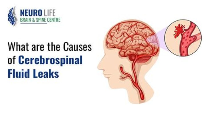 Can CSF leak heal itself?