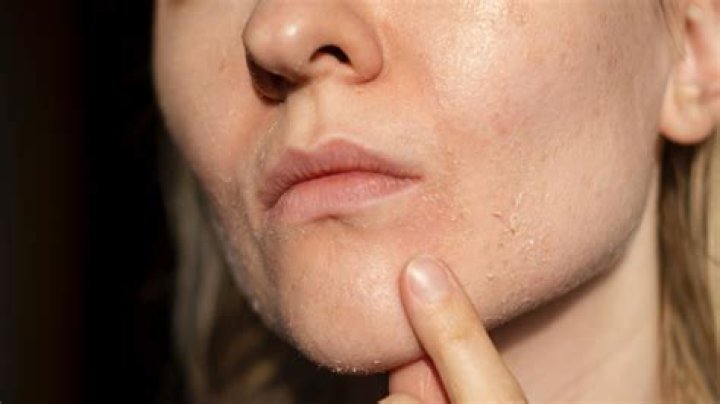 Can dryness cause pimples?