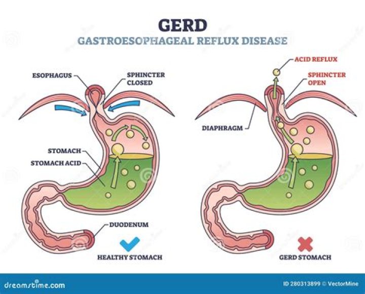 Can GERD cause gastritis?