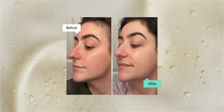 Can hyaluronic acid make you break out?