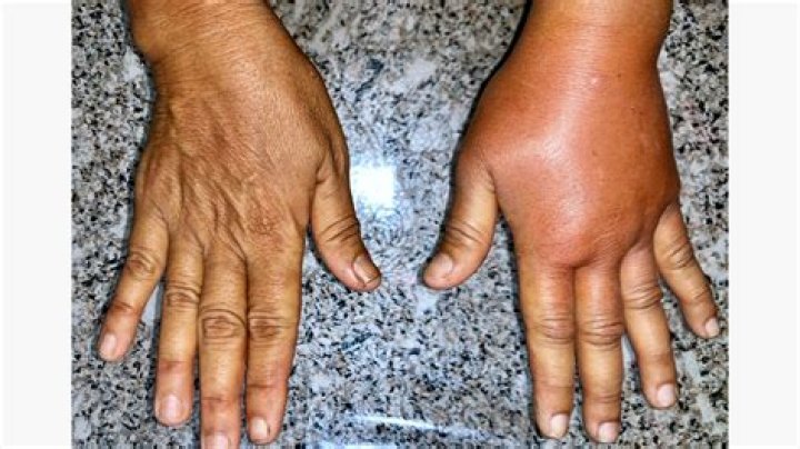 Can hypothyroidism cause swelling in hands and feet?