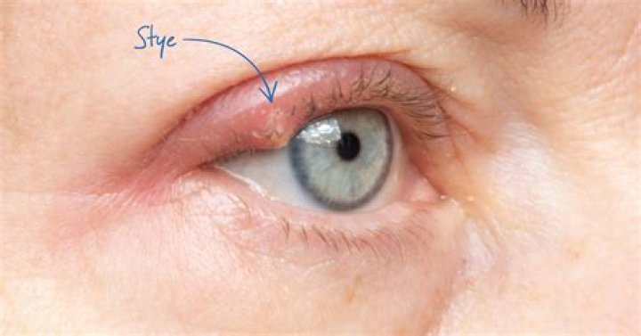Can I pop a stye with a needle?