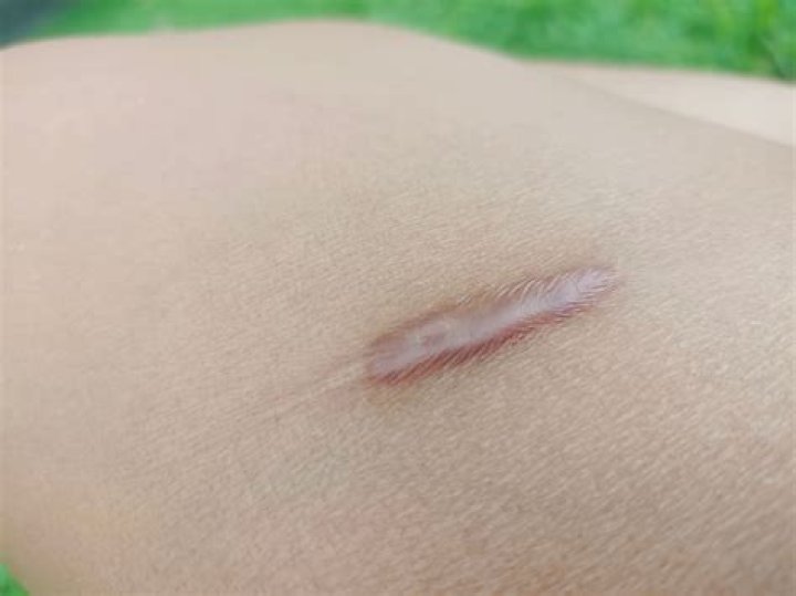 Can keloid scars go away?