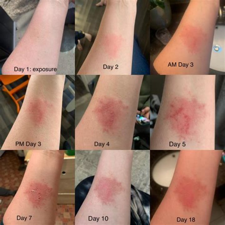 Can mortar burn your skin?