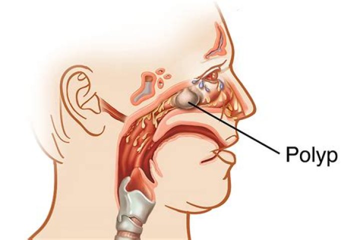 Can nasal polyps be treated without surgery?