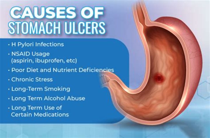 Can Stomach ulcers go away?