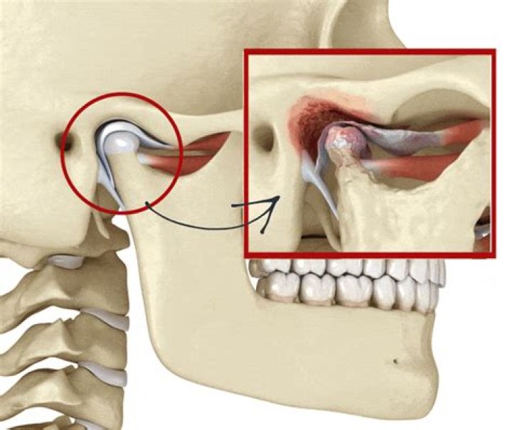 Can TMJ go away on its own?