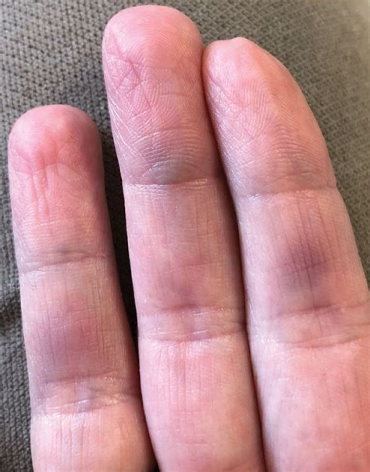 Can you burst a blood vessel in your thumb?