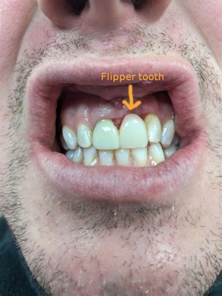 Can you eat with a flipper tooth?