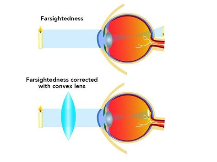 Can you fix farsightedness naturally?