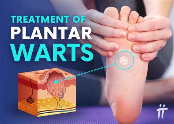 Can you get a wart from a tattoo?
