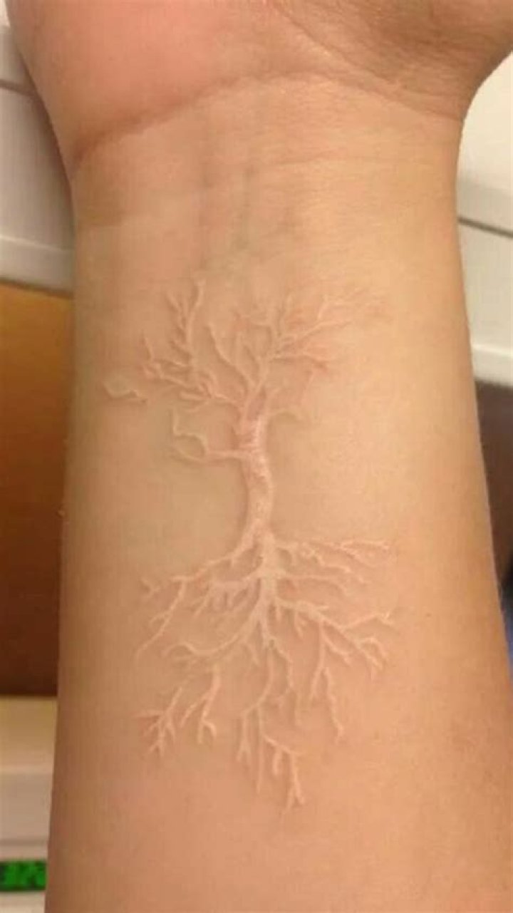 Can you get a white tattoo?