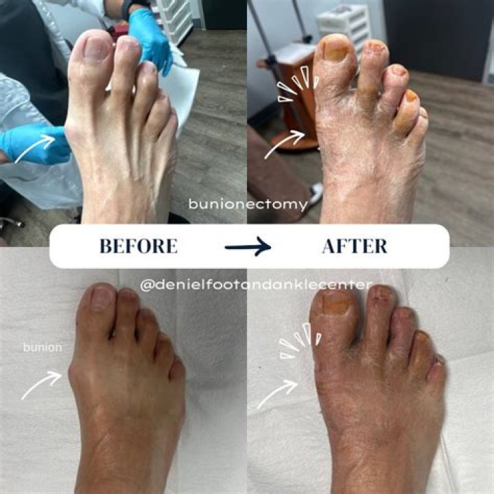 Can you get arthritis after bunion surgery?