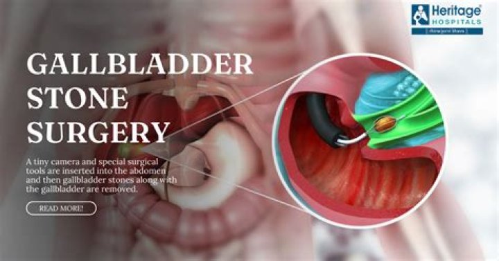 Can you get bile duct stones after gallbladder removal?