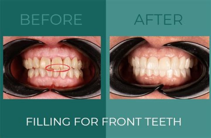 Can you get fillings on your front teeth?