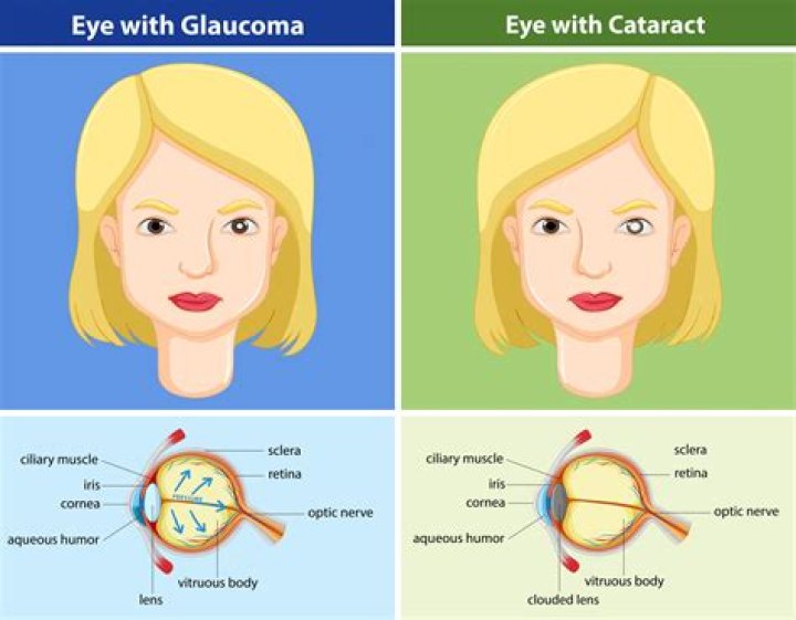 Can you go blind from lattice degeneration?