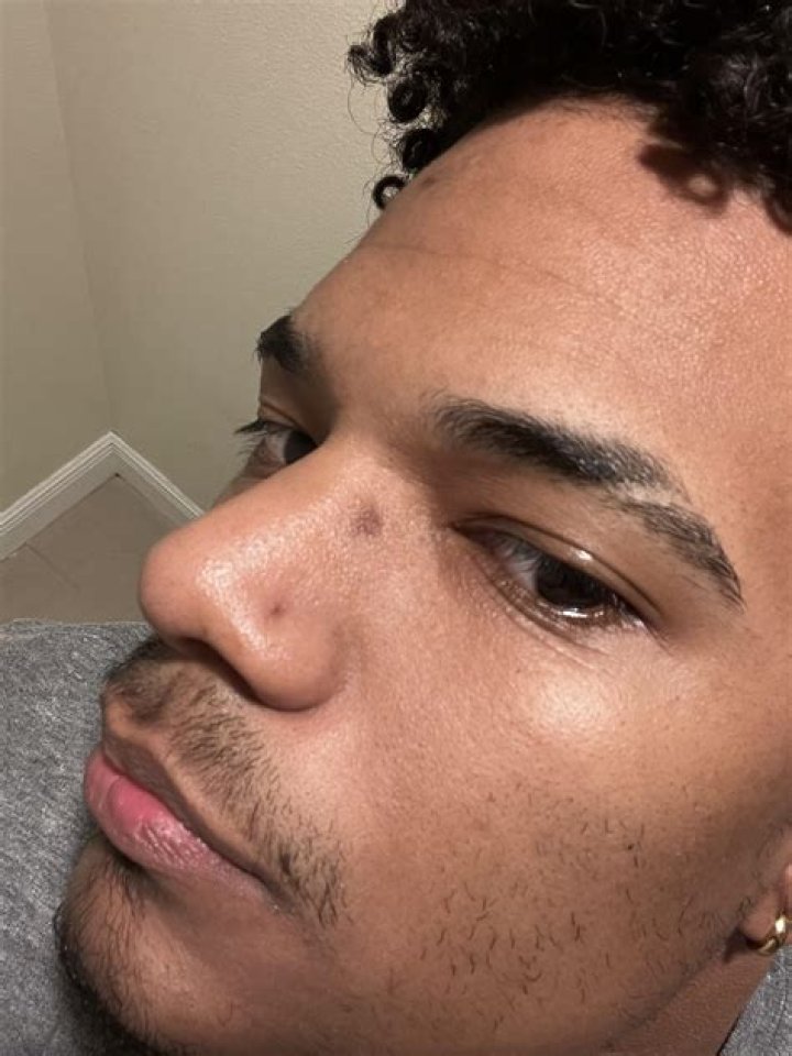Do glasses leave permanent marks?