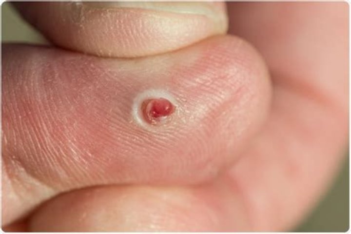 Do pyogenic granulomas go away?