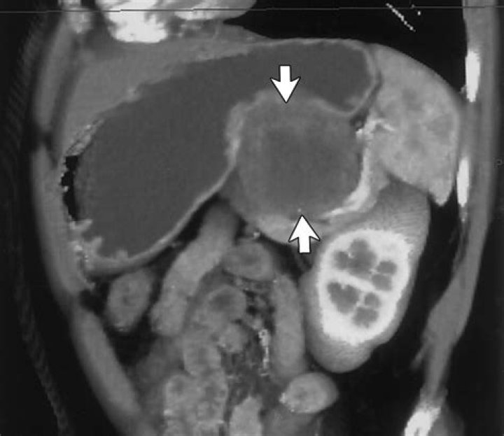 Do stomach ulcers show up on CT scan?