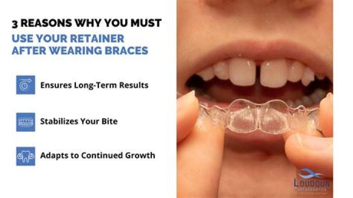 Do you get a retainer before braces?