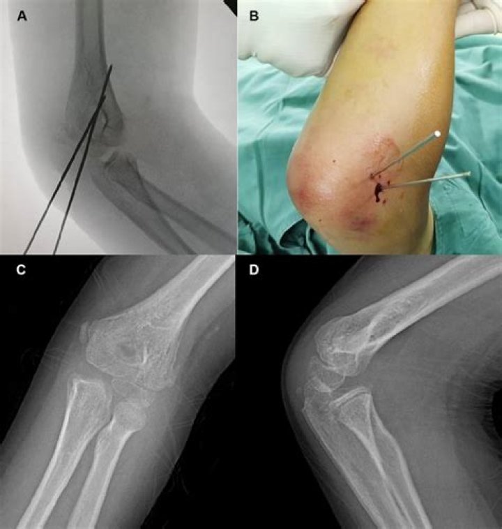 Does a closed fracture need surgery?