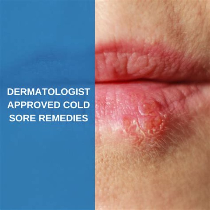 Does bactine help cold sores?