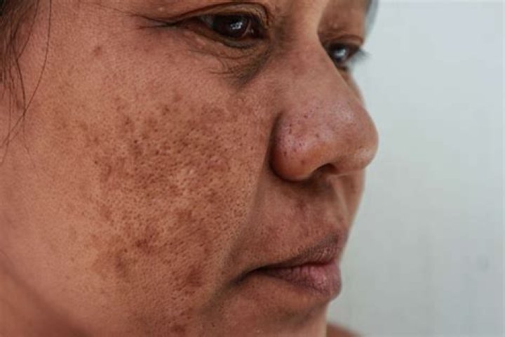 Does bleach cause skin darkening?