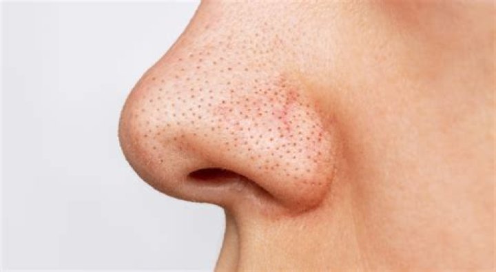 Does cinnamon get rid of blackheads?