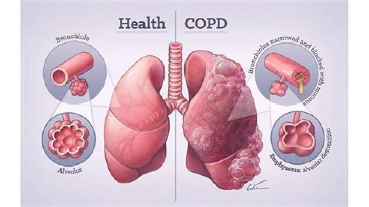 Does emphysema affect your heart?