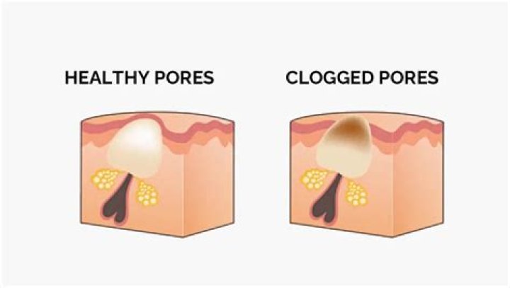 Does glycerin clog your pores?