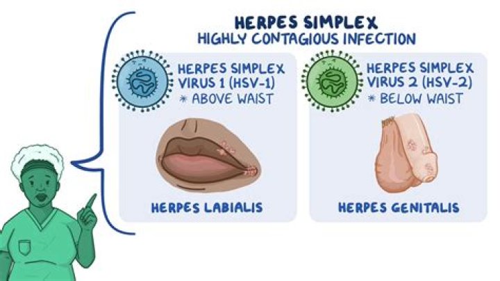 Does herpes make you sneeze?