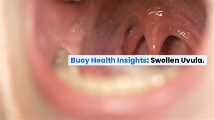 Does ibuprofen help a swollen uvula?