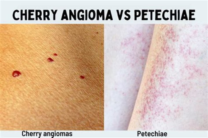 Does petechiae go away on its own?