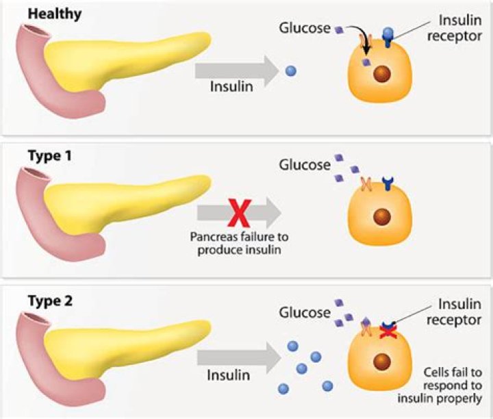 Does the pancreas produce insulin in Type 2 diabetes?