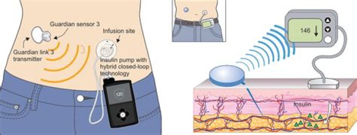 How are insulin pumps attached?