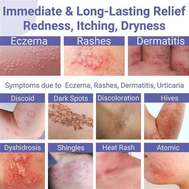 How can I dry up a rash fast?