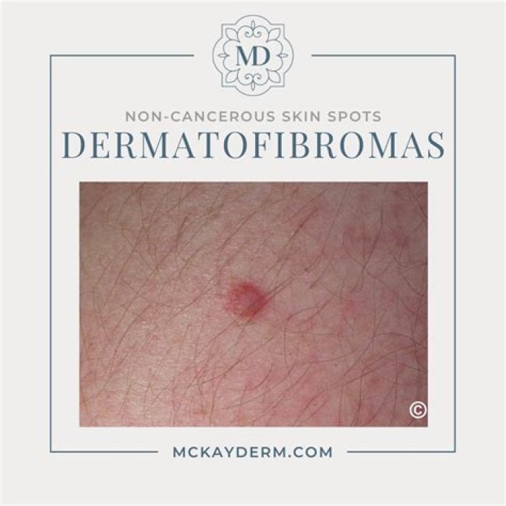 How can I remove dead skin from oily skin?