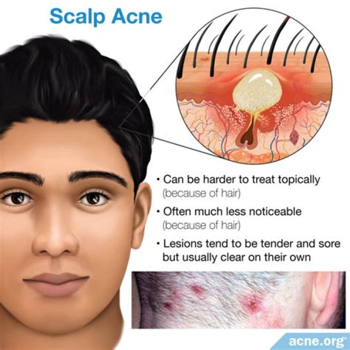 How can I remove pimples from my face?