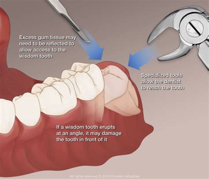 How do dentists remove baby teeth?