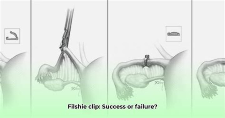 How do filshie clips work?